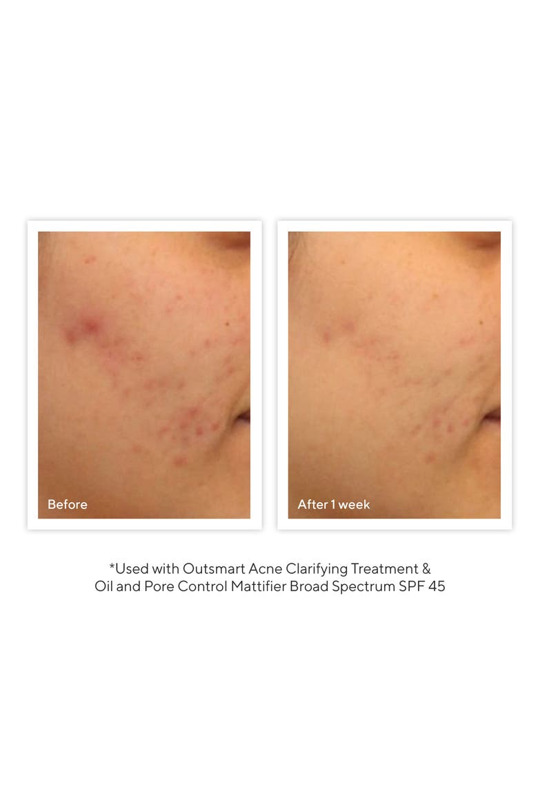 Outsmart Acne Clarifying Treatment, Alternate, color, NO COLOR