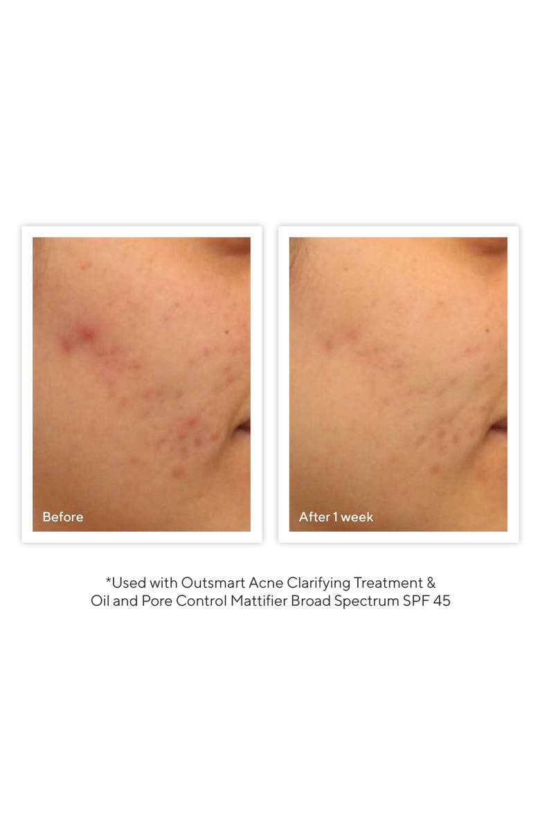 Murad<sup>®</sup> Outsmart Acne Clarifying Treatment, Alternate, color, 