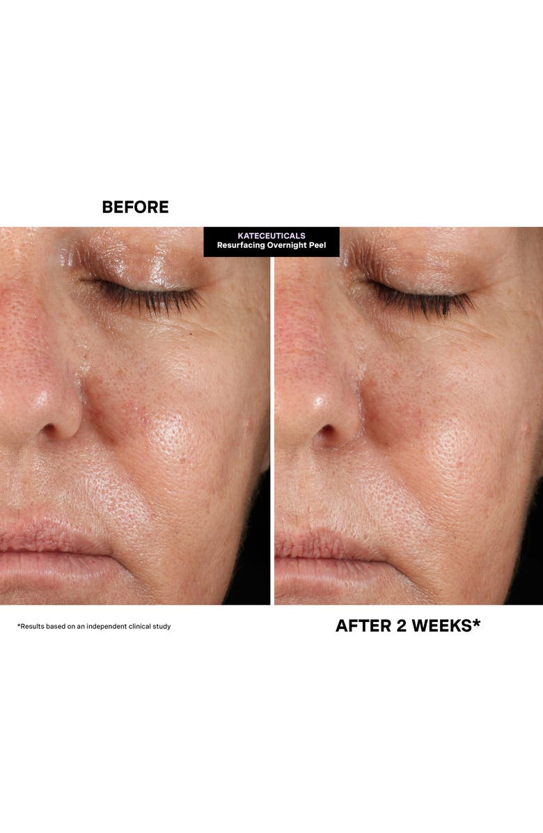 Kate Somerville<sup>®</sup> Kateceuticals<sup>®</sup> Resurfacing Overnight Peel, Alternate, color,