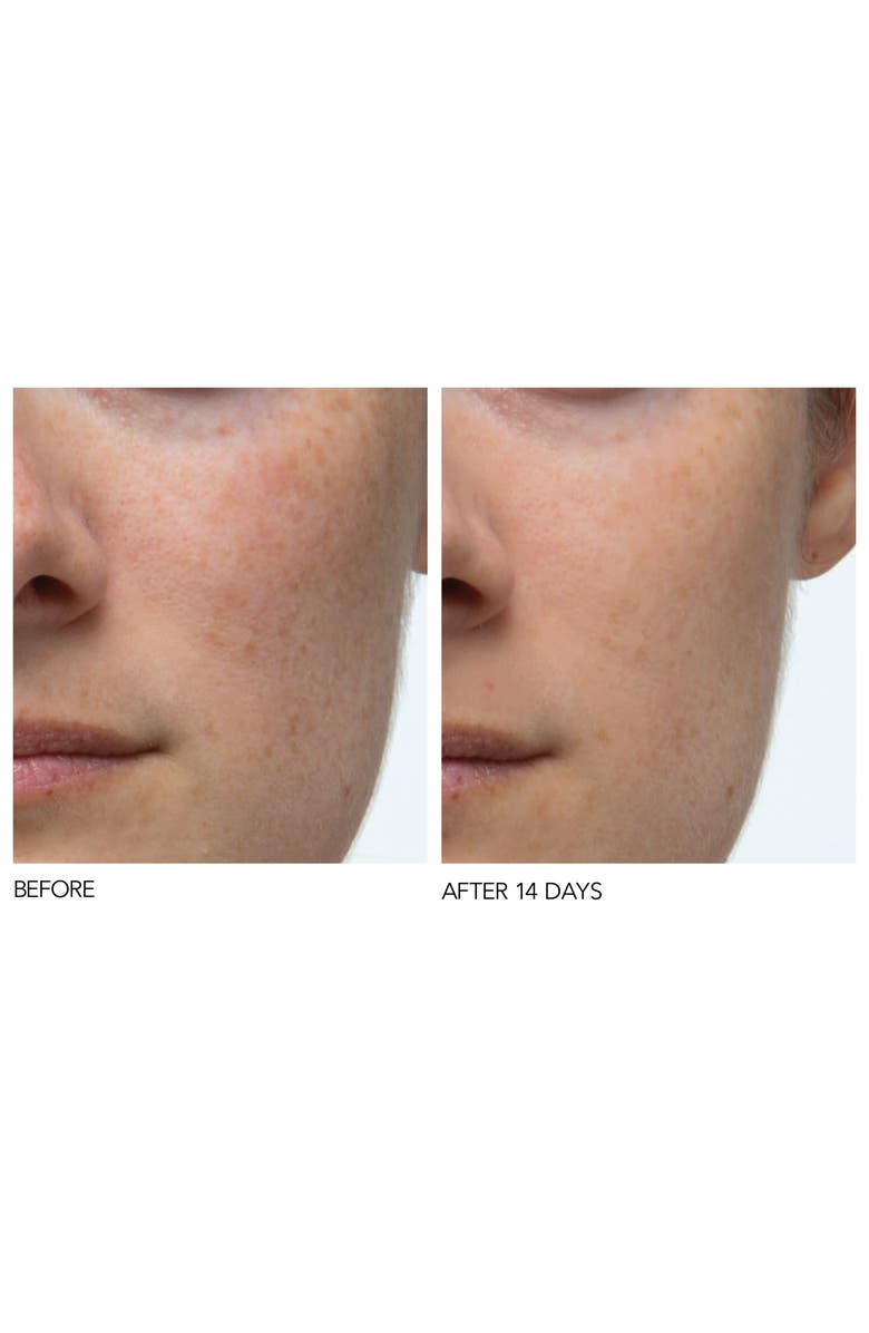 Dr. Dennis Gross Skincare Iconic Radiance Alpha Beta<sup>®</sup> Extra Strength Daily Peel, Alternate, color, 