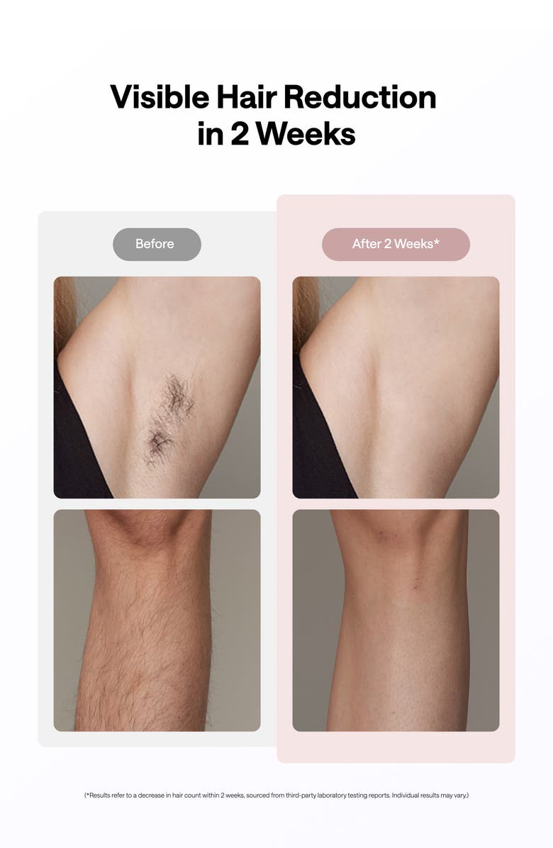 ULIKE Ice Cooling IPL Hair Removal Device, Alternate, color, Pink