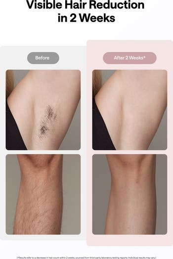 Air10 Pink Kit - Ice Cooling IPL Hair Removal Device