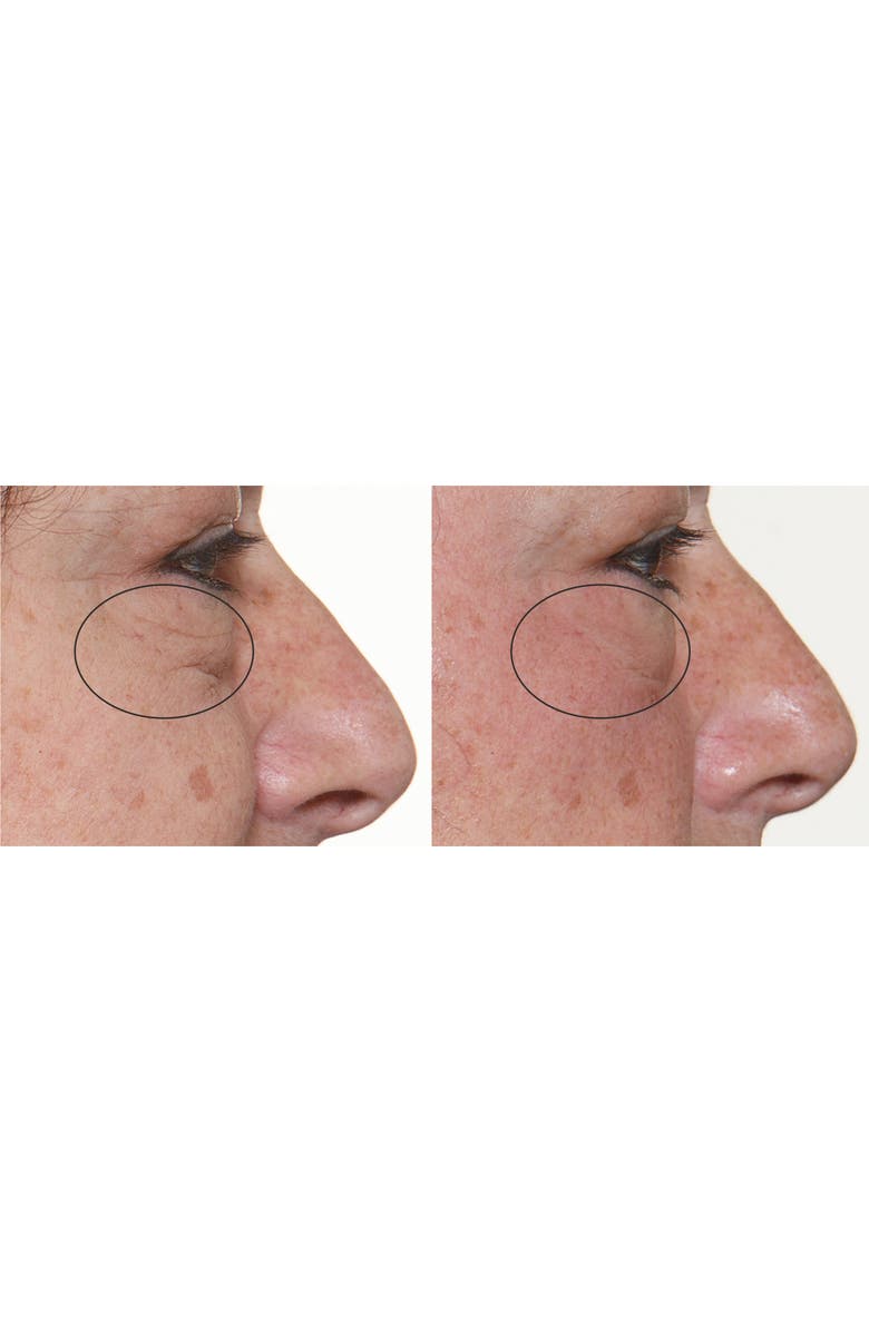 Silk'n FaceFX<sup>™</sup> Anti-Aging Device, Alternate, color, 