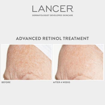 Advanced Retinol Treatment