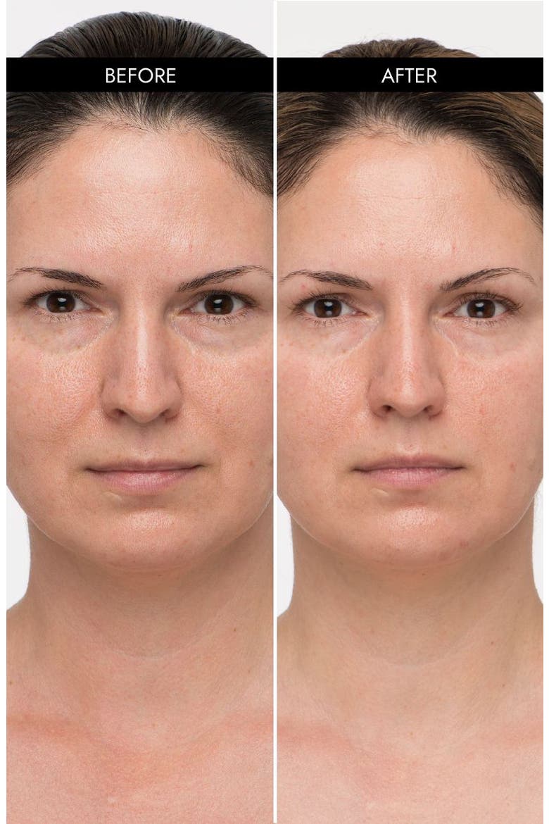 MyoLift Mini Microcurrent Facial Toning Device, Alternate, color, None