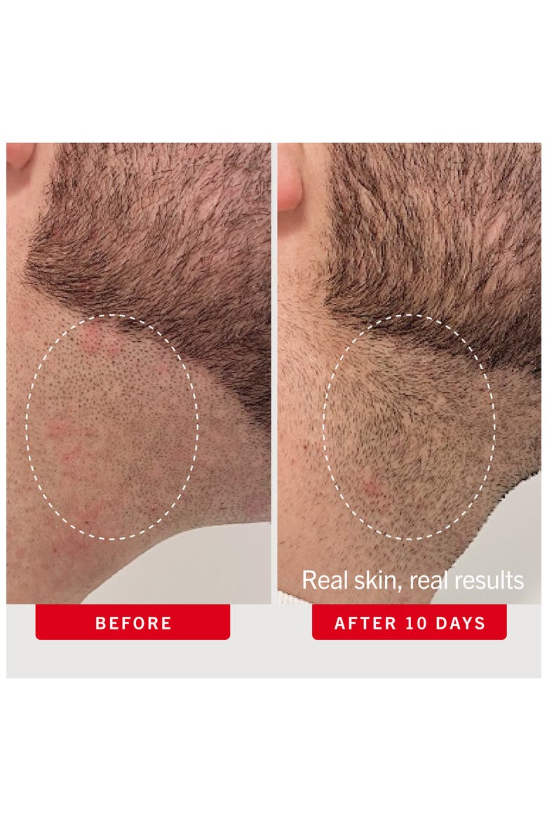 Ingrown Hair Pads Body & Face With BHA & AHA, Alternate, color, NO COLOR
