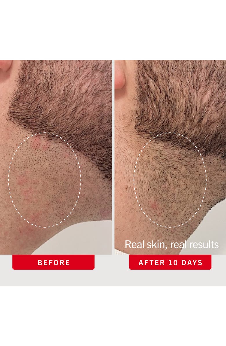 First Aid Beauty Ingrown Hair Pads Body & Face With BHA & AHA, Alternate, color, 