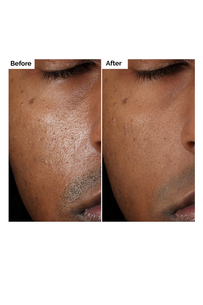 Aloe 2% + NAG 2% Solution for Post-Acne Marks, Alternate, color, NO COLOR