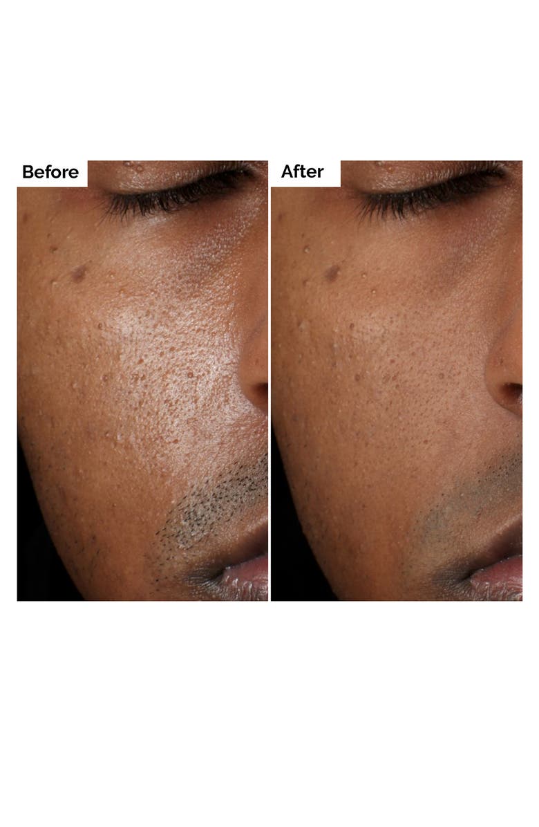 The Ordinary Aloe 2% + NAG 2% Solution for Post-Acne Marks, Alternate, color,