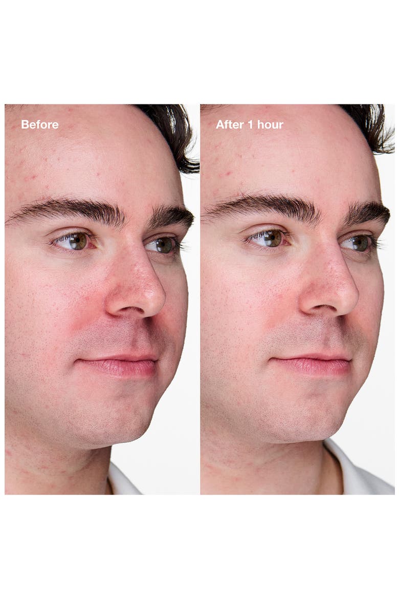 Acne Solutions™ Clinical Advanced Clearing Gel, Alternate, color, NO COLOR