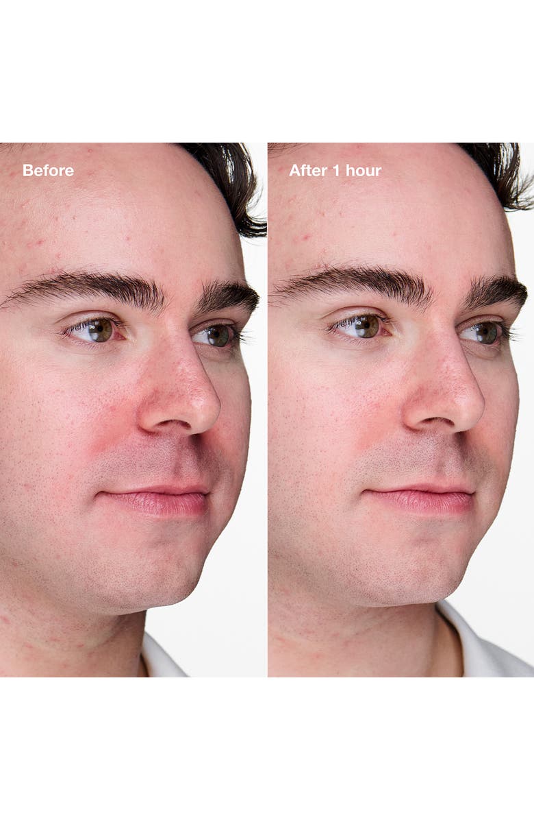 Clinique Acne Solutions<sup>™</sup> Clinical Advanced Clearing Gel, Alternate, color,