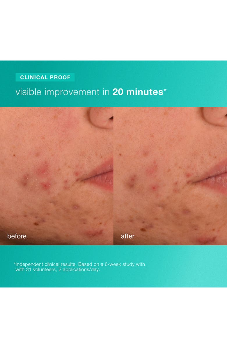 dermalogica<sup>®</sup> Acne Biotic Moisturizer, Alternate, color, 