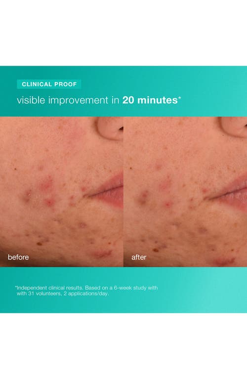 Dermalogica ® Acne Biotic Moisturizer In Transparent