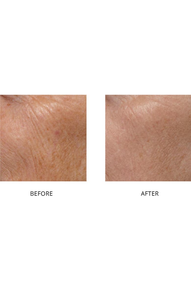 TRIA Beauty SmoothBeauty Laser, Alternate, color,