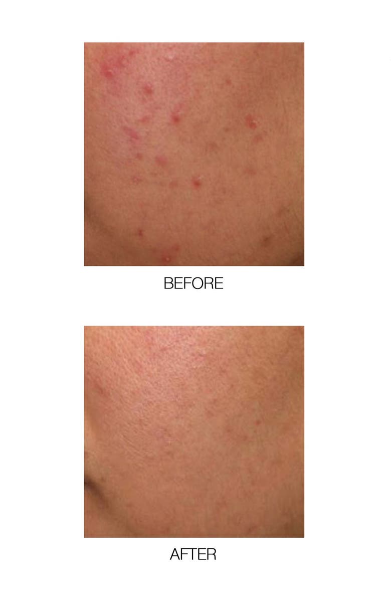 MIRENESSE Power Clear D-Blemish Hydration Serum, Alternate, color, 