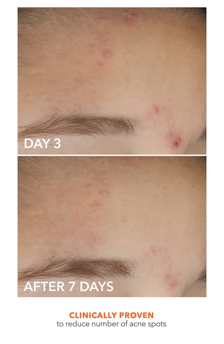 Dr. Dennis Gross Skincare Alpha Beta<sup>®</sup> On The Spot Eliminator, Alternate, color,