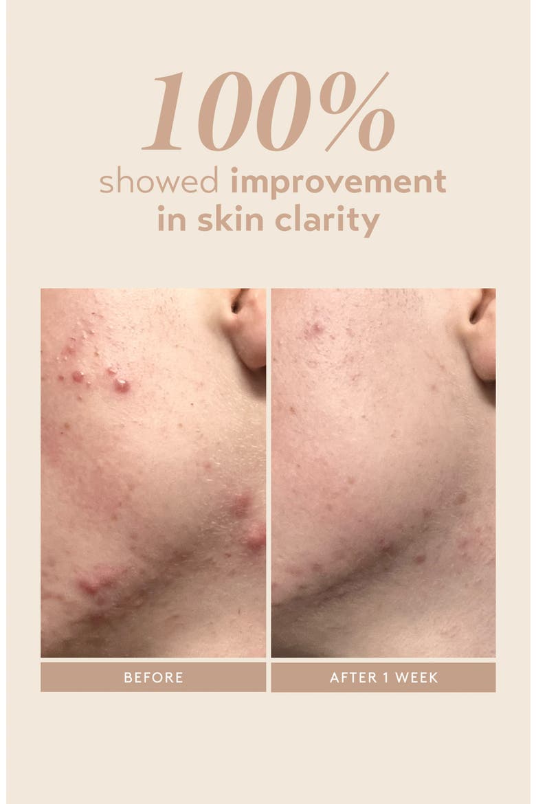 Rescue Serum with 10% Azelaic Complex, Alternate, color, NO COLOR