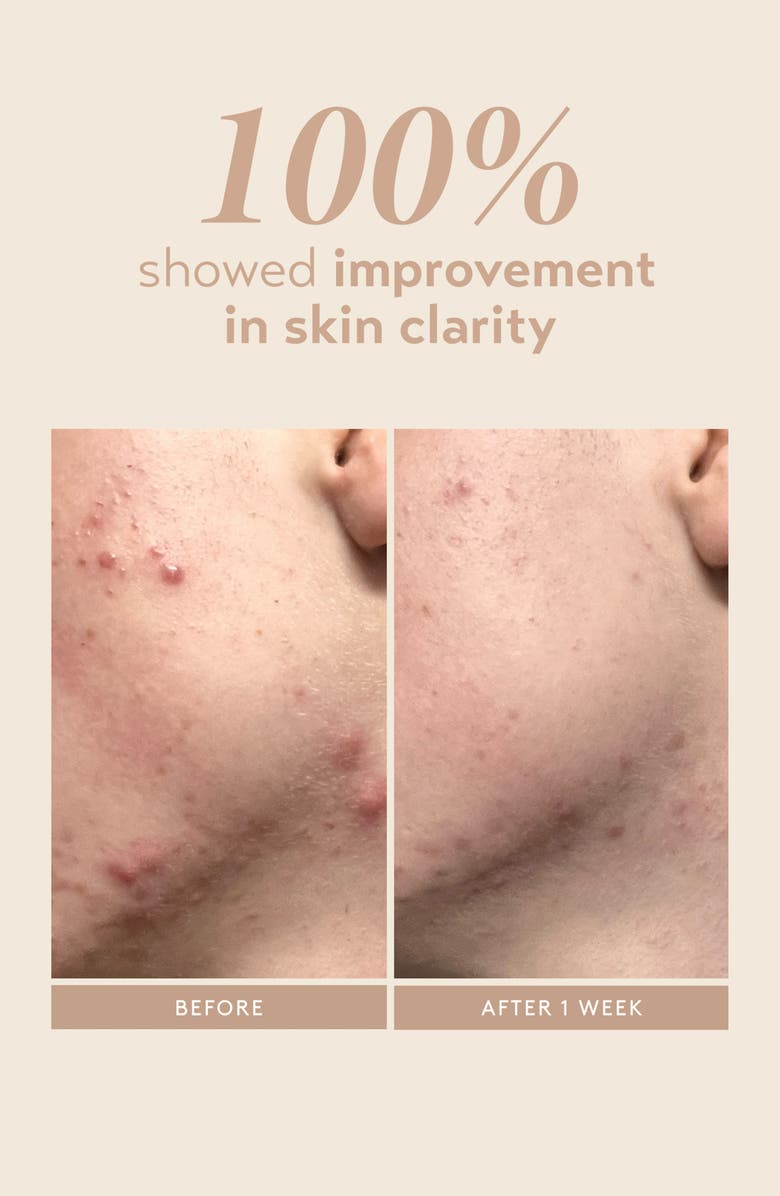 Shani Darden Skincare Rescue Serum with 10% Azelaic Complex, Alternate, color, 