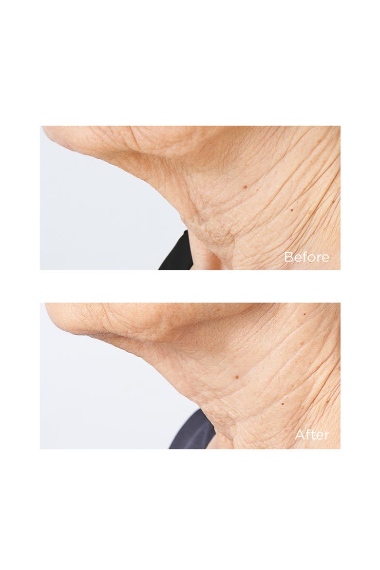 Cold Plasma+ Sub-D Neck Treatment, Alternate, color, NO COLOR