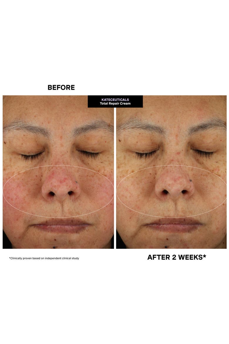 Kateceuticals® Total Repair Cream Duo $298 Value, Alternate, color, NO COLOR