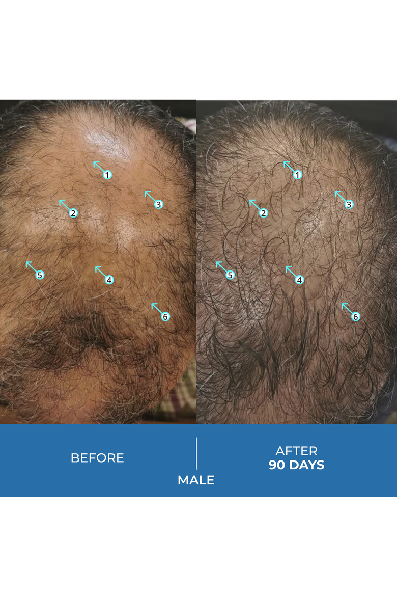 Spectral.UHP 3 Month Supply Extra Strength Hair Regrowth Treatment with Minoxidil 5%, Alternate, color, No Color