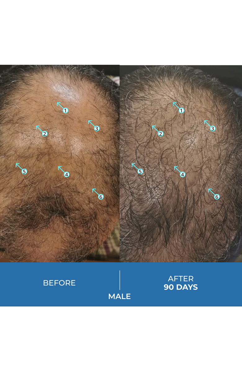 DS Laboratories Spectral.UHP 3 Month Supply Extra Strength Hair Regrowth Treatment with Minoxidil 5%, Alternate, color, NO COLOR