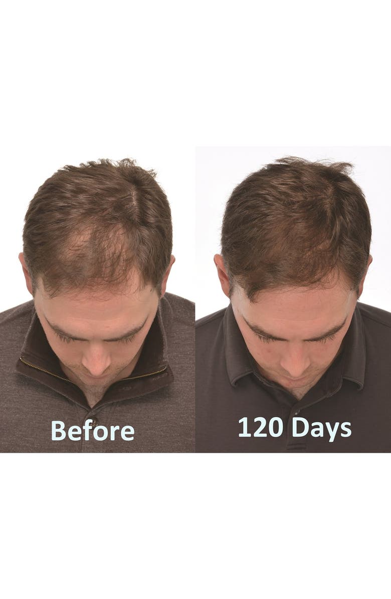 IGROW <sup>®</sup> Laser Hair Rejuvenation System, Alternate, color, 