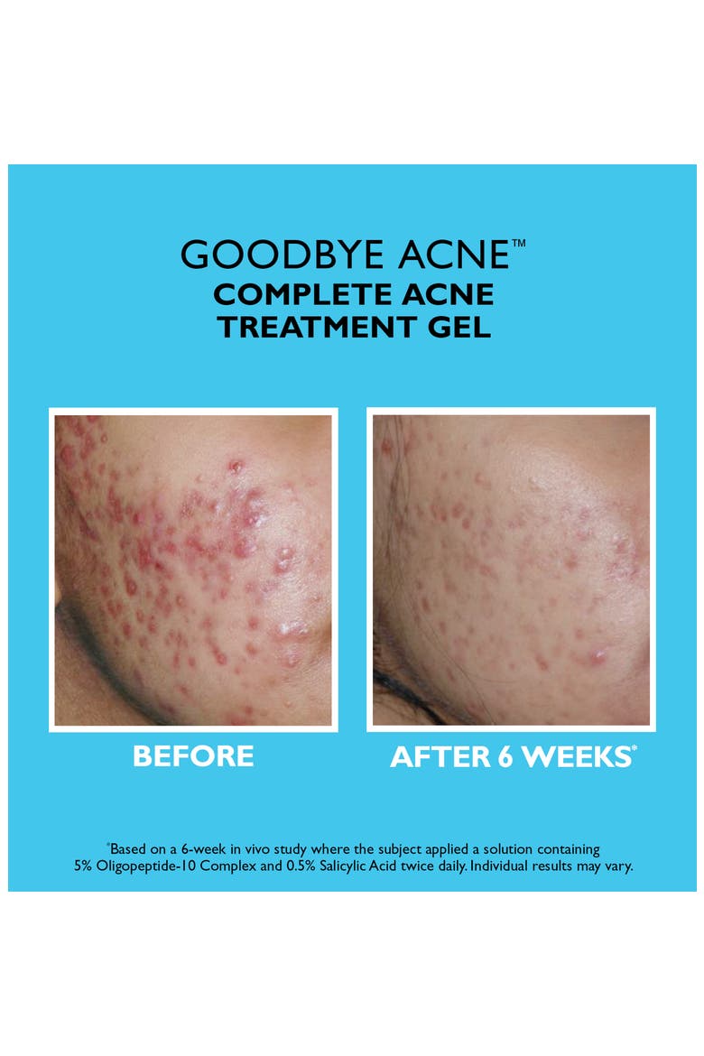 Goodbye Acne Complete Acne Treatment Gel, Alternate, color, NO COLOR