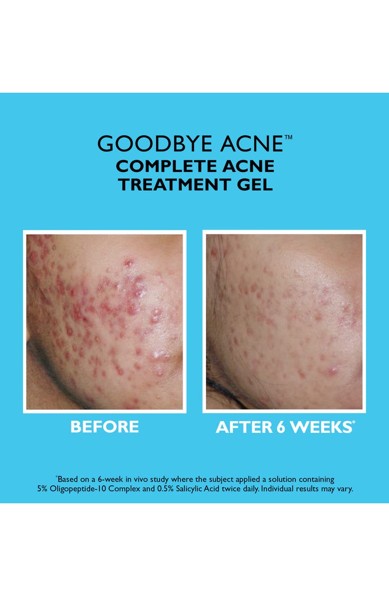 Peter Thomas Roth Goodbye Acne Complete Acne Treatment Gel, Alternate, color,