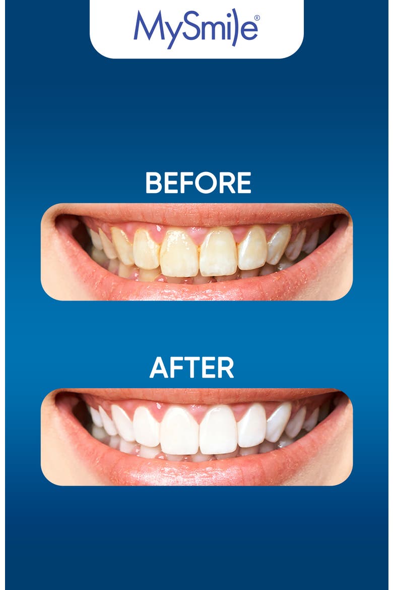 5X Original Accelerated Teeth Whitening LED Light, Alternate, color, Blue