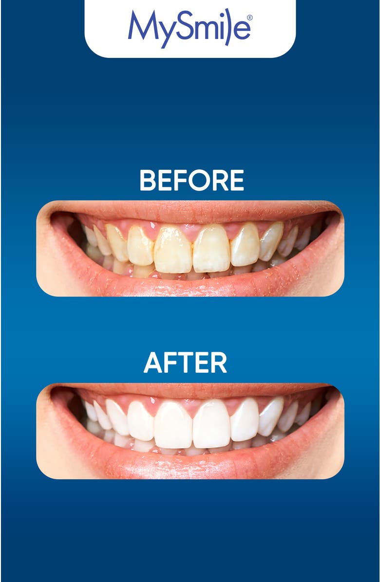 MySmile 5X Original Accelerated Teeth Whitening LED Light, Alternate, color, Blue
