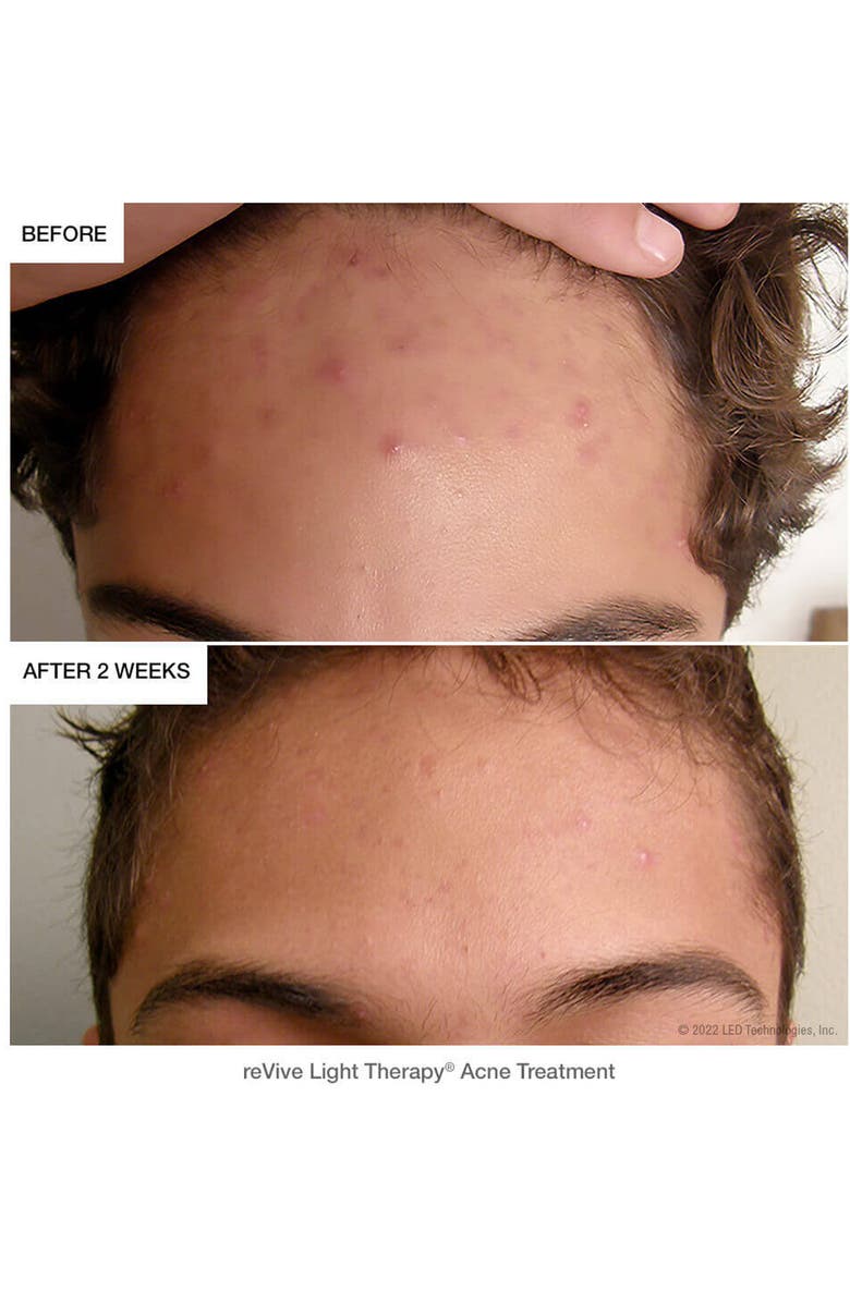 REVIVE LIGHT THERAPY Lux dpl IIa LED Full Face Wrinkle & Acne Treatment Panel, Alternate, color, 