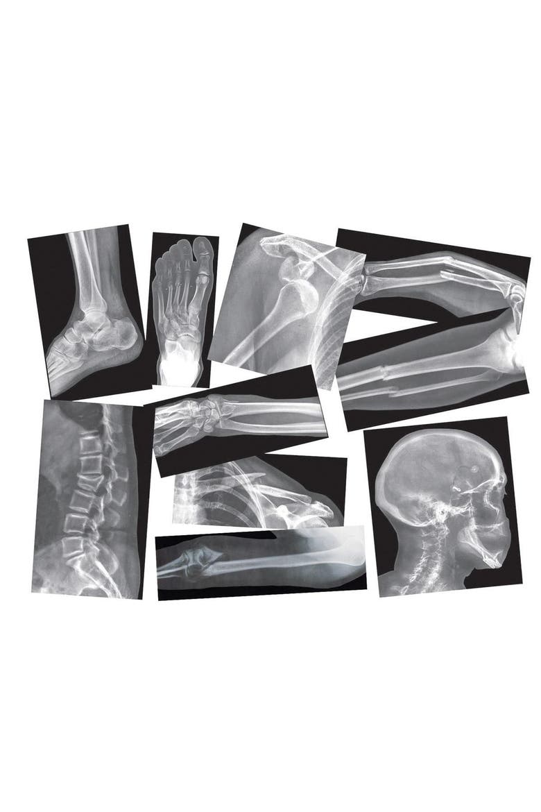 Broken Bones X-Rays, Main, color, Multicolor