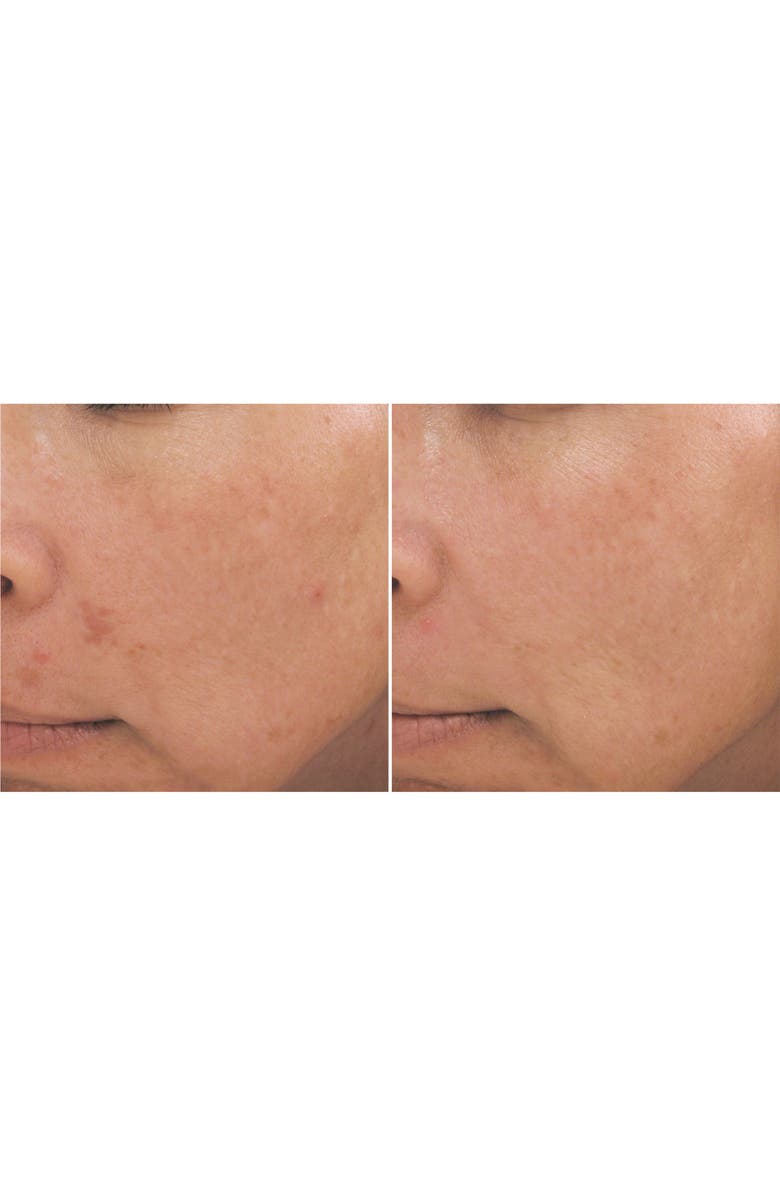 PCA Skin Intensive Brightening Treatment, Alternate, color, 