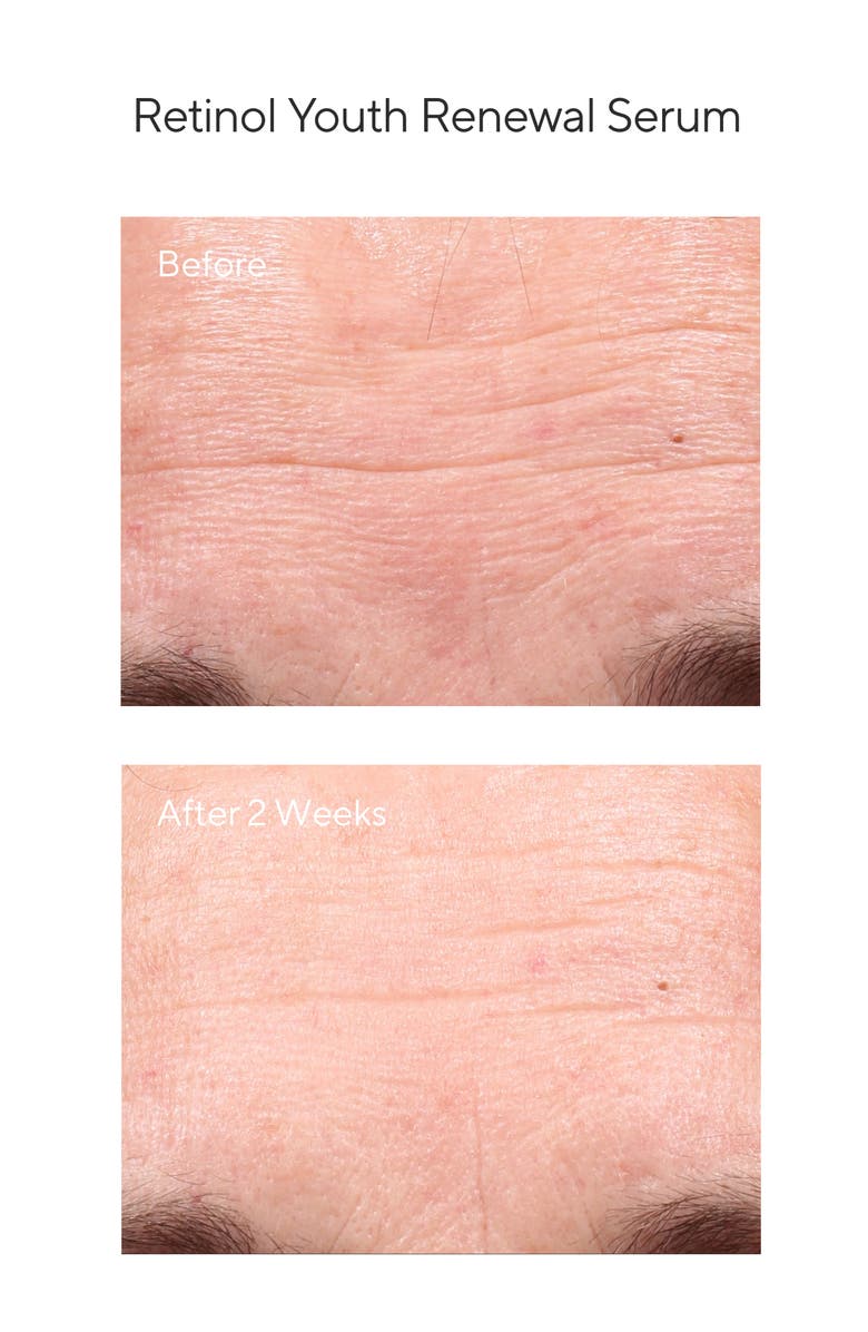 Murad<sup>®</sup> Youth Renewal Retinol Discovery Set, Alternate, color, 